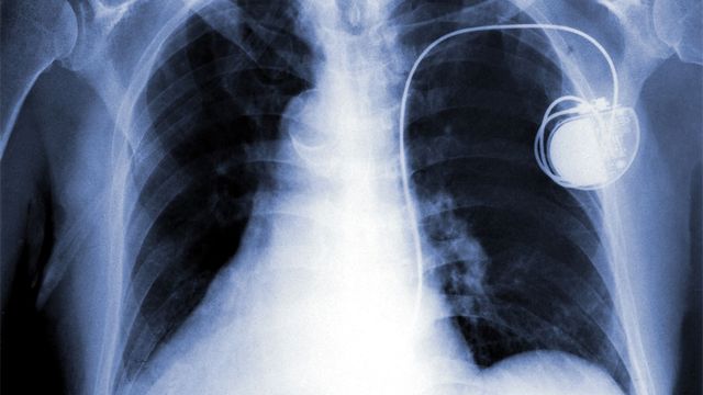 Dans le futur, les pacemakers artificiels devraient être remplacés par des techniques biologiques.
Khuruzero
Fotolia [Khuruzero - Fotolia]