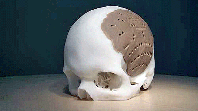 Une prothèse de crâne humain. [Oxford Performance Material]