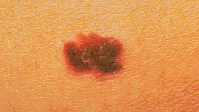 Le mélanome est une forme fortement agressive de cancer de la peau. [AP Photo/The American Cancer Society - Keystone]