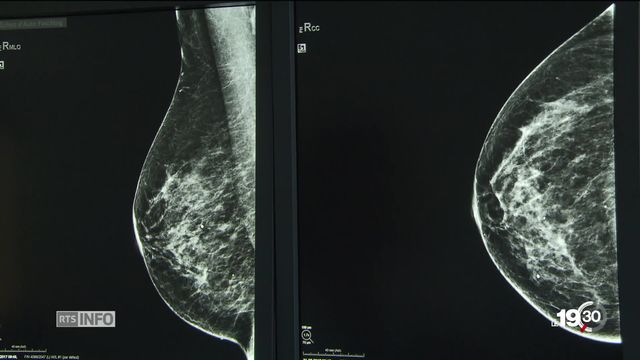 Cancer du sein, découverte majeure: Les chimiothérapies peuvent être évitées dans de nombreux cas [RTS]