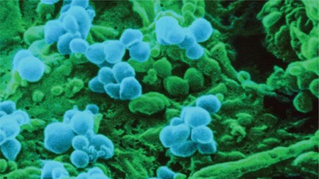 En bleu, le virus de la rougeole. Il attaque les cellules responsable de la "mémoire" immunitaire. [NIBSC - Science Source]