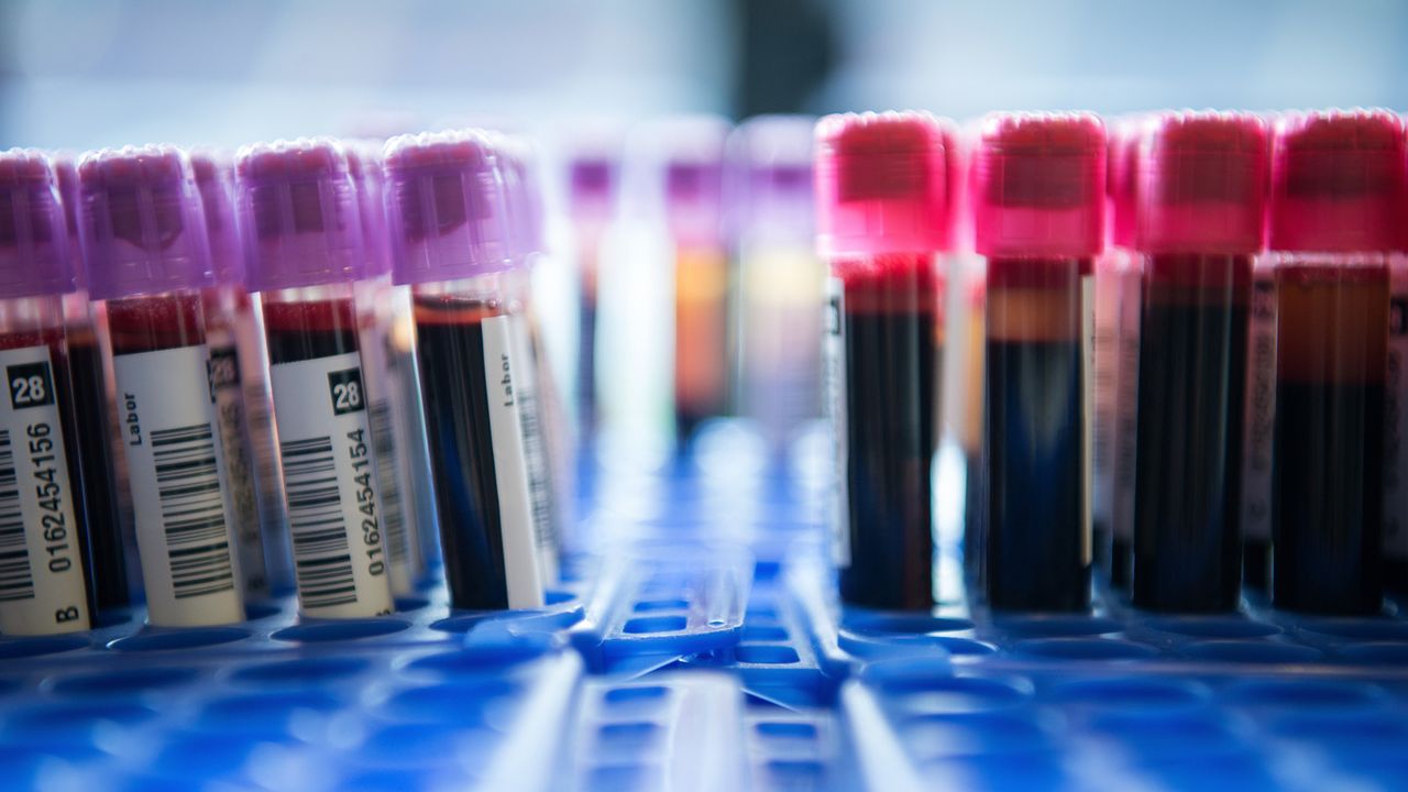 Une équipe de l'Empa et de l'hôpital cantonal de St-Gall est en train de développer un test sanguin qui devrait permettre de détecter plus simplement et précocement la maladie d'Alzheimer. Les chercheurs utilisent la microscopie à force atomique (ATM). [SEBASTIAN GOLLNOW - KEYSTONE]