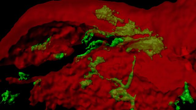 Image en 3D montrant l’invasion de cellules de cancer du sein (en vert) exprimant ZEB1 dans un tissu osseux de souris (en rouge). [Didier Picard - UNIGE]