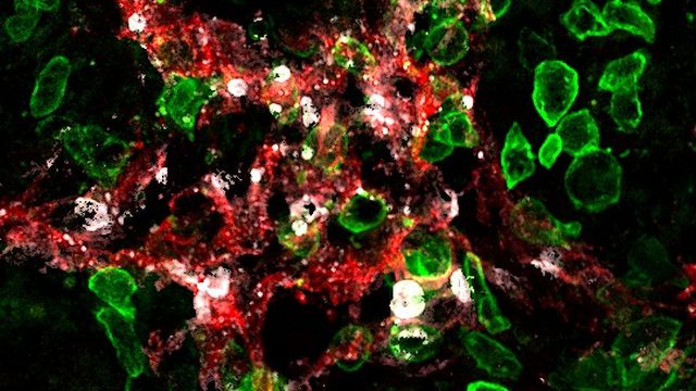 Les lymphocytes tueurs (en vert) attaquent les vaisseaux lymphatiques (en rouge) dans la tumeur, et entraînent leur mort (marqueur de mort cellulaire en blanc).
Stéphanie Hugues
Unige 2022 [Stéphanie Hugues - Unige 2022]
