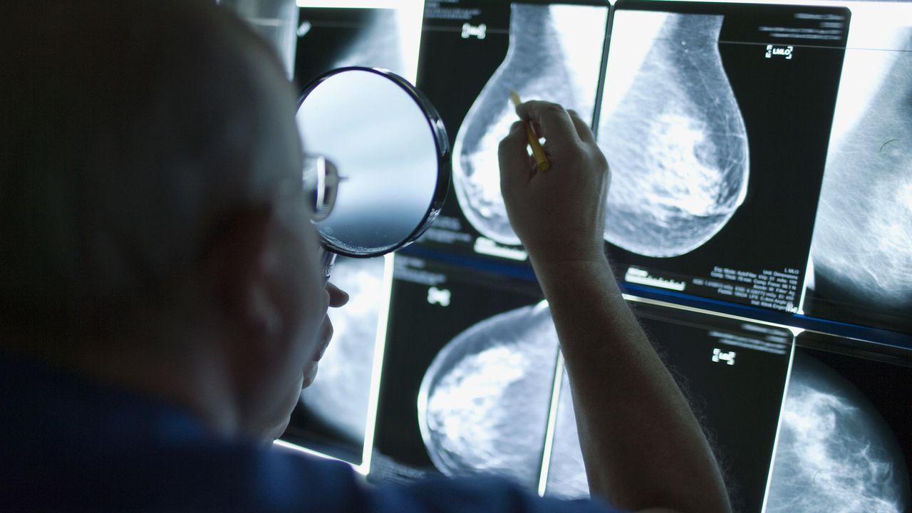 Un radiologiste examine les images d'une mammographie, pour détecter un possible cancer du sein. [Gaetan Bally - Keystone]