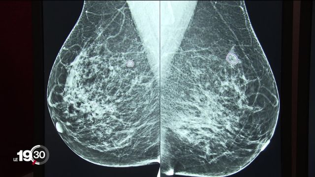 Cancer du sein: l'espoir dans les traitements [RTS]
